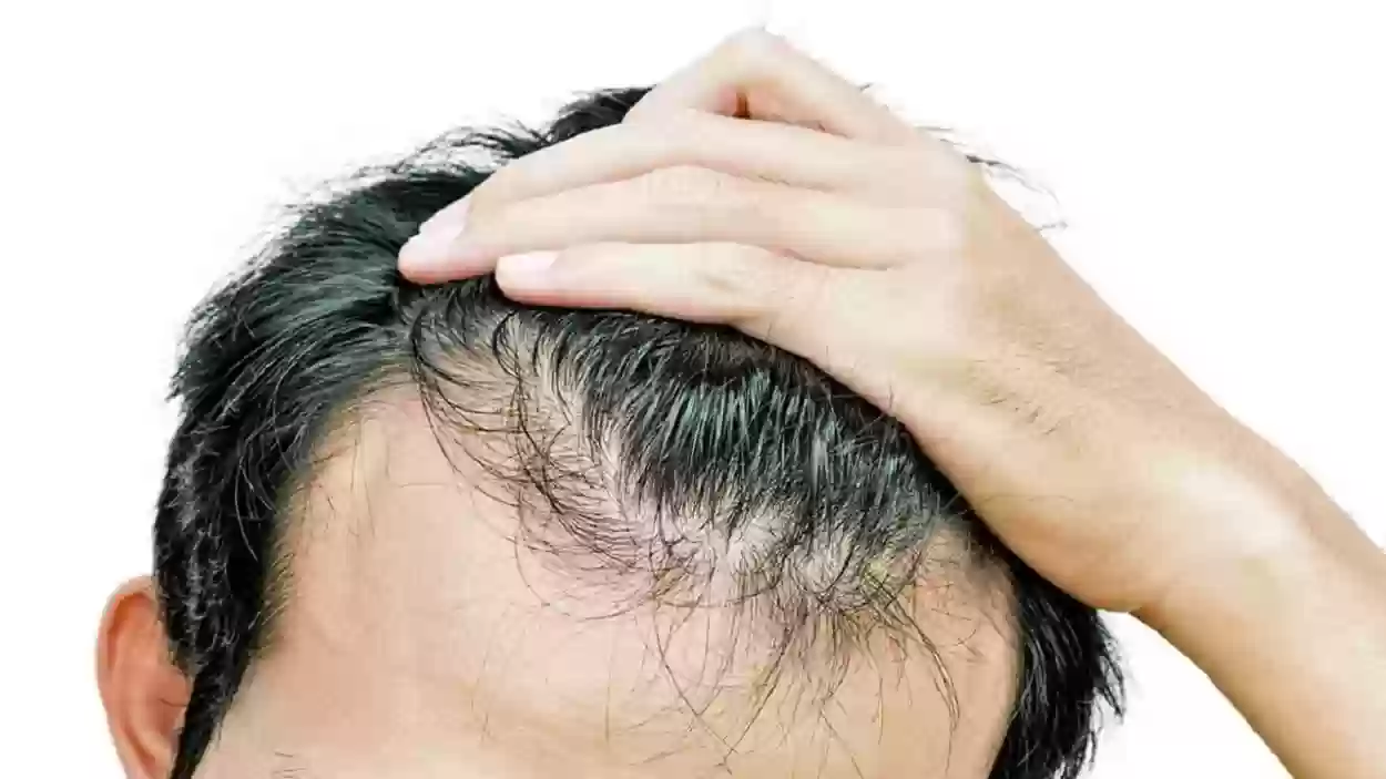 الآن وخلال أيام معدودة يمكن التخلص من مشكلة تساقط الشعر