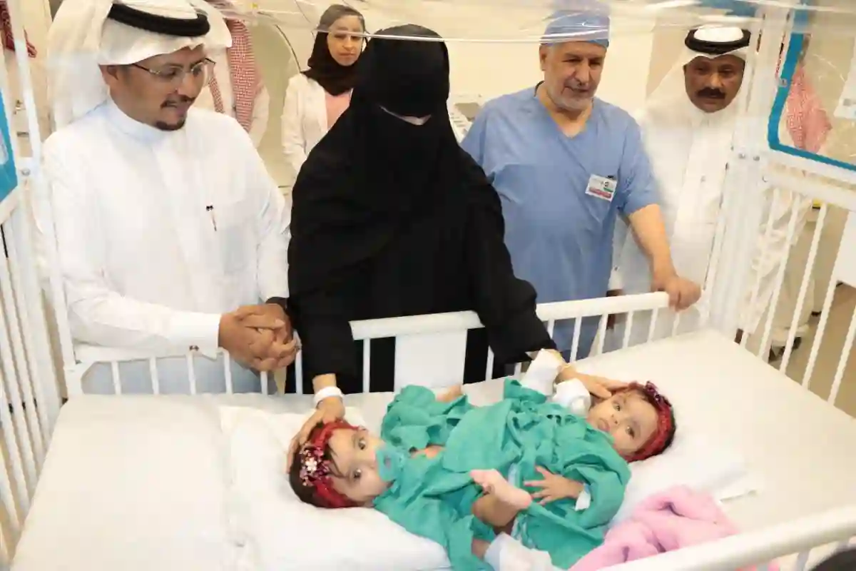 فصل التوائم الملتصقة